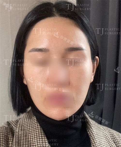 韩国TJ整形外科脂肪填充术后正面照 韩国TJ整形外科脂肪填充术后正面照