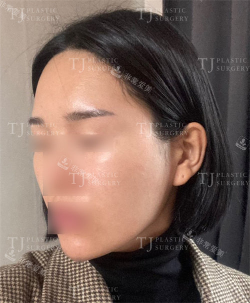 韩国TJ整形外科脂肪填充术后恢复图 韩国TJ整形外科脂肪填充术后恢复图