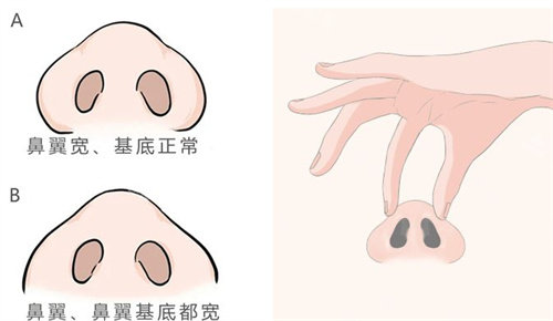 鼻翼过宽情况手术方法图