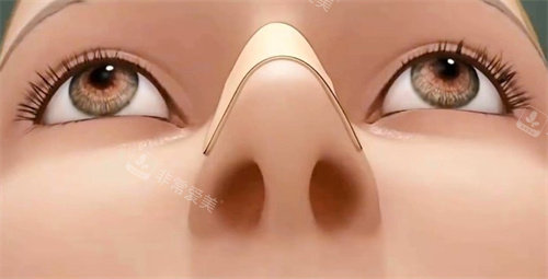 假体隆鼻手术动画参考图