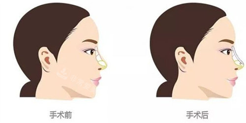 假體隆鼻前后對比參考圖 假體隆鼻前后對比參考圖