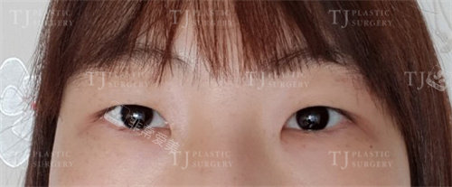 韩国TJ整形外科双眼皮术前照