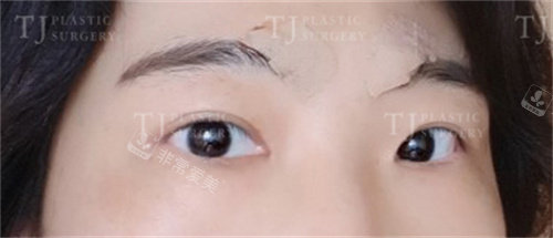 韩国TJ整形外科双眼皮术后侧面照