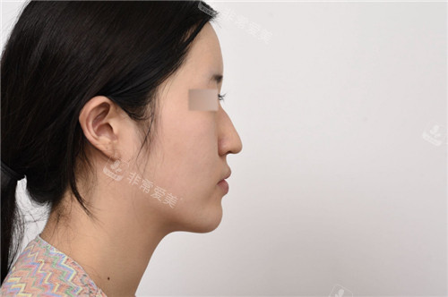 GNG整形醫(yī)院鼻部整形術前