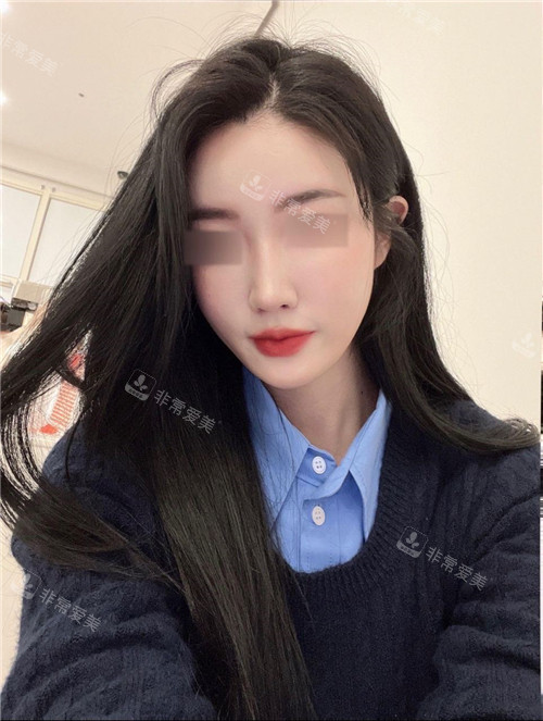 GNG整形醫(yī)院鼻部整形術后
