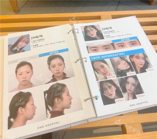 GNG整形醫(yī)院真人整形前后對比圖冊