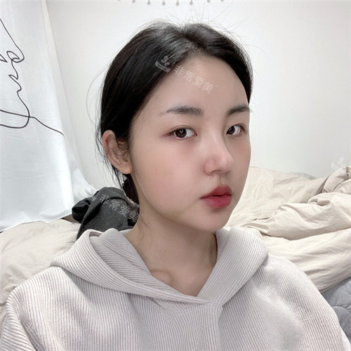 韓國現(xiàn)代美學(xué)整形輪廓三件套術(shù)后半個(gè)月 韓國現(xiàn)代美學(xué)整形輪廓三件套術(shù)后半個(gè)月