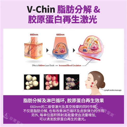 V-Chin激光溶脂作用介紹