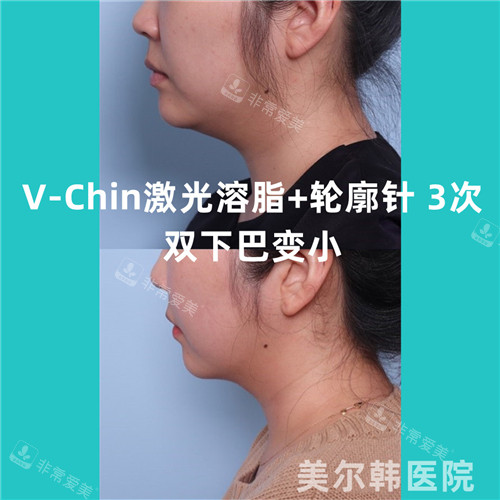 美尔韩医院V-Chin下巴溶脂激光+轮廓针3次对比照