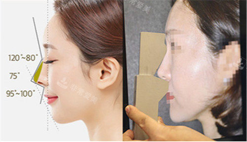 韩国will整形外科隆鼻手术测量