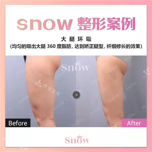 韩国SNOW整形外科大腿环吸前后图