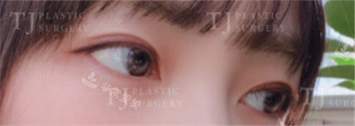 韩国tj整形眼部手术后照片