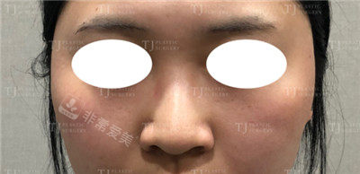 韩国tj整形鼻翼手术前照片