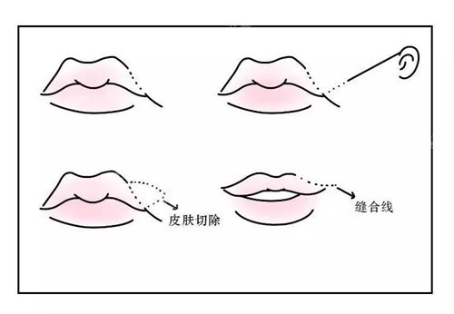 唇部手術(shù)示意圖 唇部手術(shù)示意圖