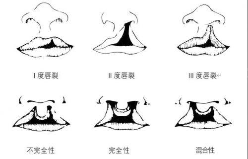 唇裂示意图