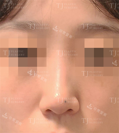 韩国TJ整形外科隆鼻术前照