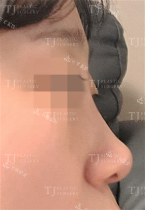 韩国TJ整形外科术前隆鼻侧面照