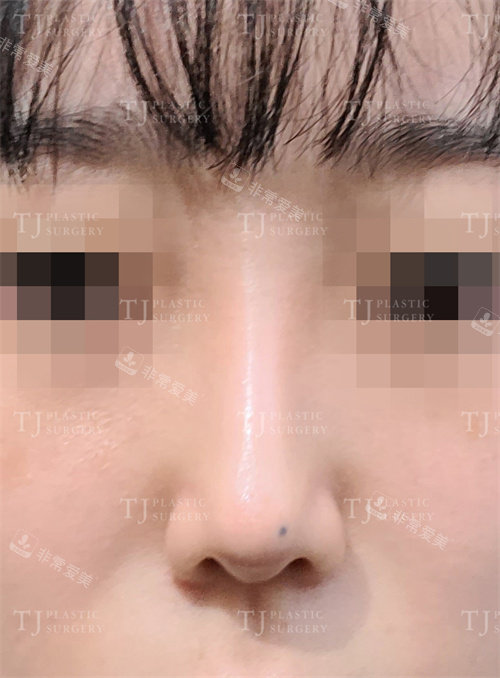 韩国TJ整形外科隆鼻术后图