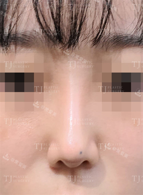 韩国TJ整形外科隆鼻术后图 韩国TJ整形外科隆鼻术后图