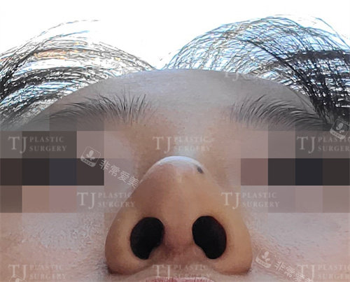 韩国TJ整形外科隆鼻术后俯拍图