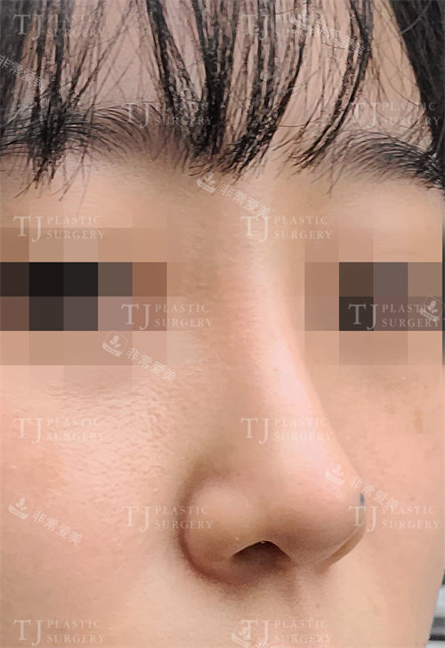 韩国TJ整形外科真人隆鼻手术展示图