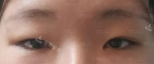 韩国TJ整形外科切开双眼皮+开眼角术前