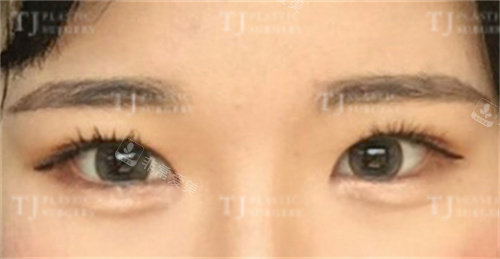 韩国TJ整形外科切开双眼皮+开眼角术后图片