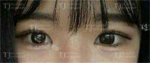 韩国TJ整形外科切开双眼皮+开眼角术后图