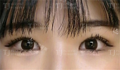 韩国TJ整形外科切开双眼皮+开眼角手术对比图