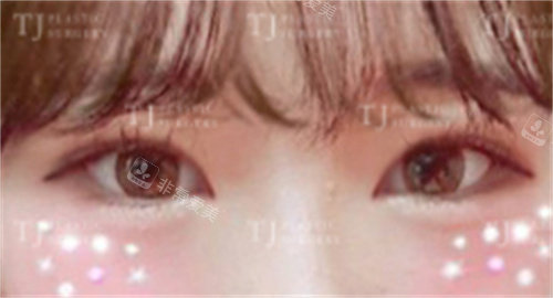 韩国TJ整形外科切开双眼皮+开眼角术后图片
