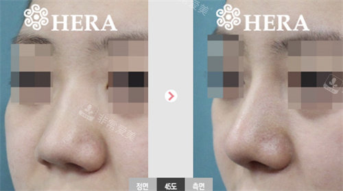 韩国赫拉整形隆鼻隆鼻特色：立体旋翼鼻是人气招牌！