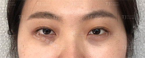 韩国TJ整形去眼袋黑眼圈术前 韩国TJ整形去眼袋黑眼圈术前