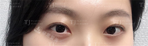 韩国TJ整形去眼袋黑眼圈术后图片