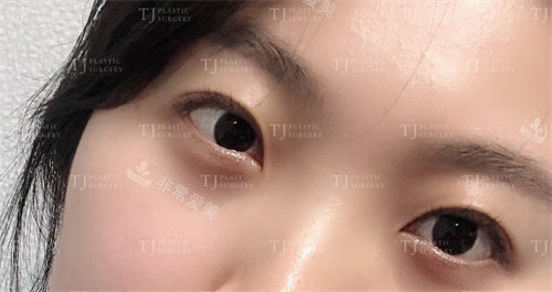 韩国TJ整形去眼袋黑眼圈术后对比图