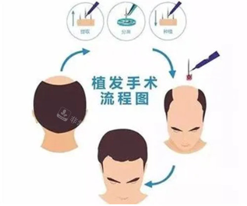 植發(fā)手術(shù)動(dòng)畫流程圖 植發(fā)手術(shù)動(dòng)畫流程圖