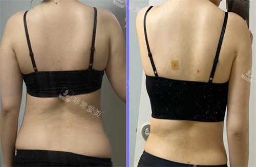 韩国宝士丽整形外科背部吸脂手术图