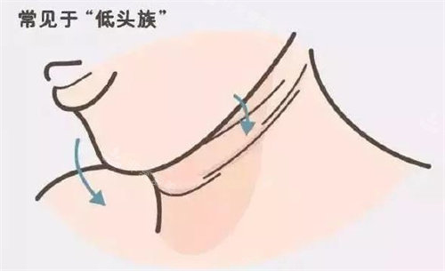 后天姿勢錯誤形成的頸紋圖