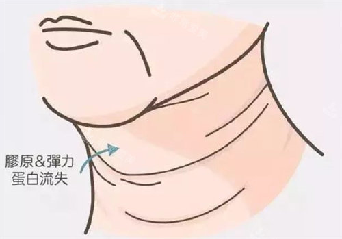 老化型頸紋動畫參考圖