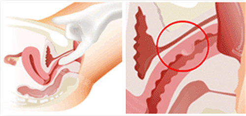 女性G点手术