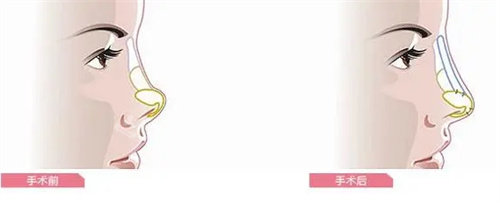 隆鼻前后動畫對比圖 隆鼻前后動畫對比圖