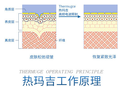 热玛吉工作原理展示图