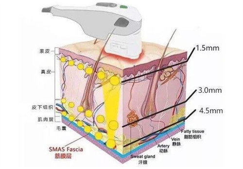 热玛吉工作时皮肤变化图 热玛吉工作时皮肤变化图