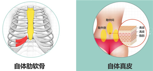 自體軟骨隆鼻材料