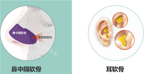 鼻中隔軟骨和耳軟骨隆鼻材料