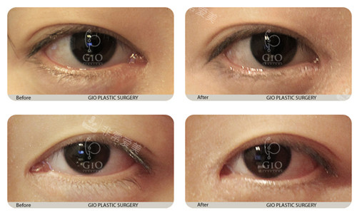 GIO整形外科内眼角复原术对比照