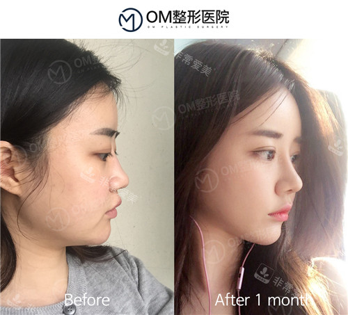 韩国OM整形外科鼻整形对比照