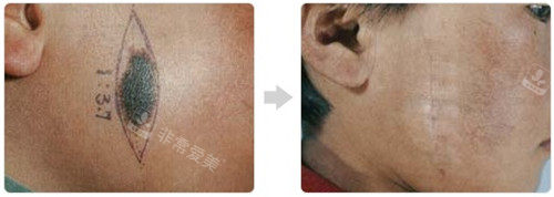 韩国Dr.hams疤痕医院胎记治疗图片