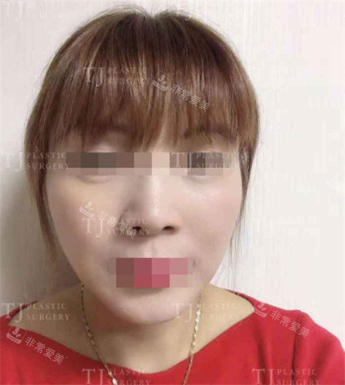 韩国TJ整形面部脂肪填充手术术后图片