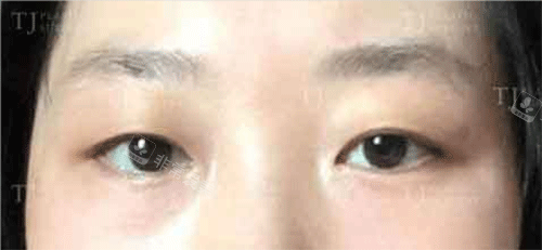 韩国TJ整形眼部手术前照片