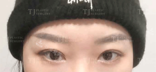 韩国tJ整形眼部手术后照片